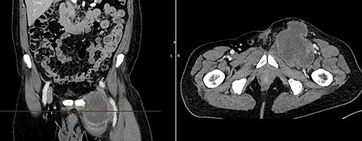 CT of the abdomen from 26 July 2023: size-progressive metastasis in the left groin with infiltration of the adductor muscles; no dynamics in the primarily osteoplastic diffuse osseous metastasis.