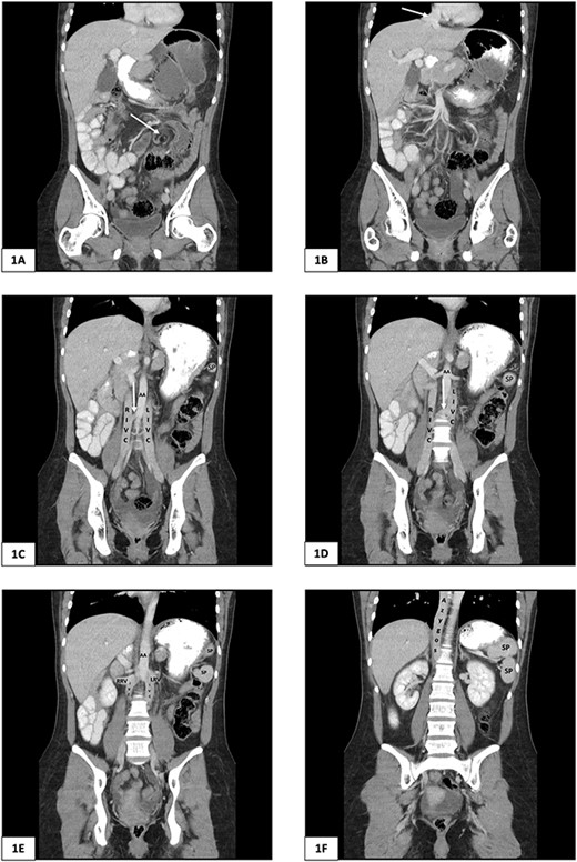 Computed tomography of the abdomen and pelvis of 25-year-old female presenting with caecal volvulus, intestinal malrotation, duplicate inferior vena cava, azygos continuation of the IVC, and fragmentation of the spleen. RIVC, right inferior vena cava; LIVC, left inferior vena cava; RRV, right renal vein; LRV, left renal vein; AA, abdominal aorta; SP, splenic fragment. (A) Arrow indicates mesenteric whirl sign. (B) Arrow indicates suprahepatic IVC draining from right, middle, and left hepatic veins into the right atrium. (C) and (D) Arrow indicates communicating vein from right IVC to left IVC.