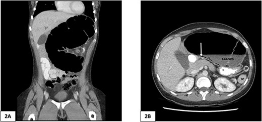 Computed tomography of the abdomen and pelvis of 25-year-old female patient. (A) Coronal slice demonstrating caecal volvulus with distended loop of colon. (B) Axial slice demonstrating 97 mm diameter distended caecum, multiple splenic fragments, arrow indicates pneumatosis coli, indicating colonic ischaemia. SP, spleen fragments.