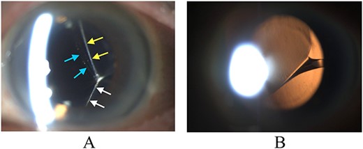 Biomicroscopy of anterior segment on presentation. (A) Illumination using a slit beam coming from the examiner’s left side shows the anterior surface of the IOL (blue arrows) and the posterior capsule superiorly (yellow arrows) and inferiorly (white arrows). The IOL is severely tilted and the posterior capsule is tented backwards by the inferior edge of the IOL. (B) Retroillumination shows IOL malpositioning because of the twisted haptic.