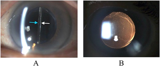 Biomicroscopy of anterior segment at the first postoperative month following remedial surgery. (A) Illumination using a slit beam coming from the examiner’s left side shows the anterior surface of the IOL (blue arrow) and the posterior capsule (white arrow). (B) Retroillumination shows good IOL centration.