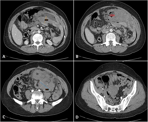 Multiple axial cuts of the patient’s abdomen CT scan with IV contrast are shown. Extensive bowel wall thickening up to 3 cm is noted, involving a long segment of small bowel loops in the left abdomen (jejunal loops) with a gray pattern of enhancement (A). Additionally, a wall defect/perforation is seen with the surrounding pneumoperitoneum and spillage of fecal material within the peritoneal cavity (B). Associated multiple enlarged adjacent mesenteric lymph nodes are also demonstrated, forming a large mass-like lesion with surrounding fat stranding (C). Moreover, mild wall thickening involving another short segment of small bowel loops in the right abdomen (ileal loops) is also noted (D).