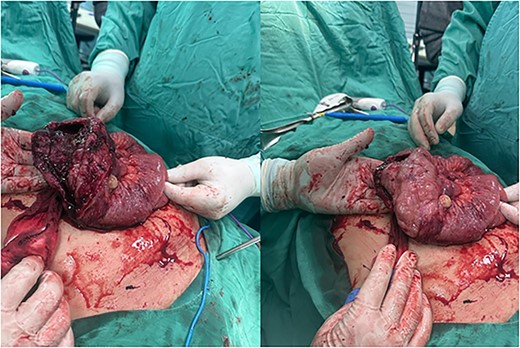 Intraoperative view of perforated small bowel tumor.