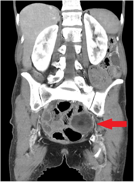 Coronal view of initial CT scan demonstrating left adnexal dermoid cyst (arrow).