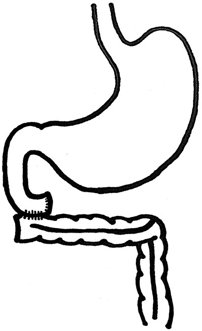 Diagrammatic representation of the handsewn two-layer duodenocolonic anastomosis.