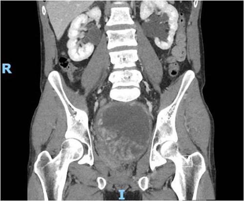 Contrast CT pelvis (May 2020) showing stable complex solid and cystic pelvic mass abutting displacing the bladder superiorly and the prostate laterally.