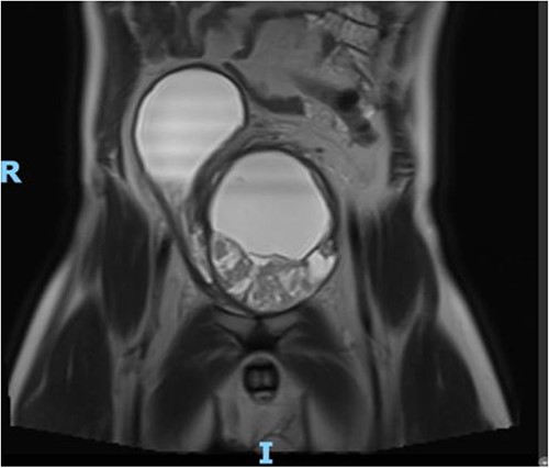 MRI Pelvis (contrast) June 2021: well-marginated complex solid, cystic, and septated pelvic mass with multiple sites of enhancement and restricted diffusion; the mass appears to communicate with the bladder neck.