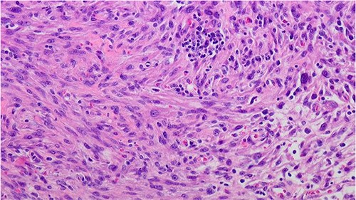 Prostate leiomyosarcoma (high grade/poorly differentiated) 200×: the tumor shows marked nuclear atypia and pleomorphic nuclei.