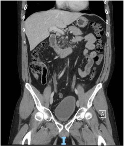 Contrast CT pelvis at 20 months post-surgery showing no residual disease.