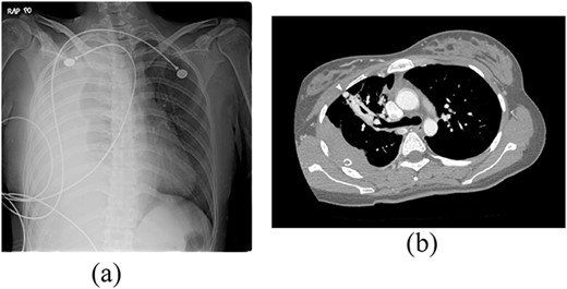 Radiograph of a 24-year-old woman with chest pain and dyspnea. (a) Chest radiograph showing right massive effusion causing left shifting of the mediastinum. (b) Enhanced axial CT showing the direct connection of a branch of the anterior segmental pulmonary artery (down arrow) with a vein (up arrow) and dilated vessel on the surface of the anterior segment of the right upper lung (arrowhead).