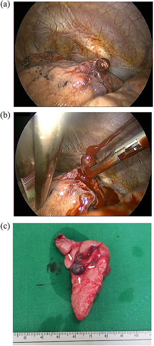 Operative findings. (a) The right upper lobe had a PAVM protruding from the anterior segment of the right upper lung. (b) Active bleeding from the PAVM. The PAVM is very friable and easy to rupture even with soft palpation. (c) Resected lung specimen. The PAVM is observed as a dilated blood vessel (arrow).