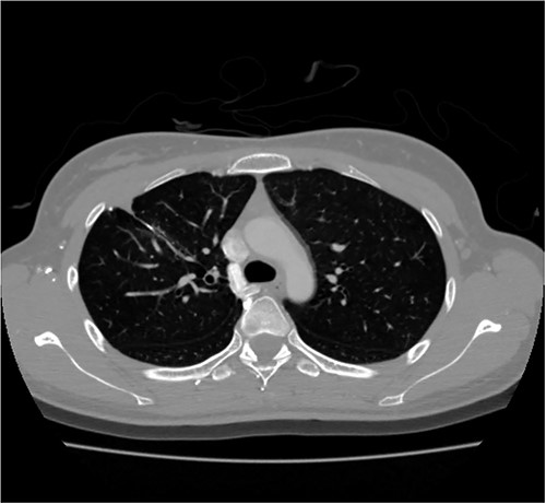 Contrast-enhanced chest CT after 8 months. Chest radiograph reveals no residual PAVM.