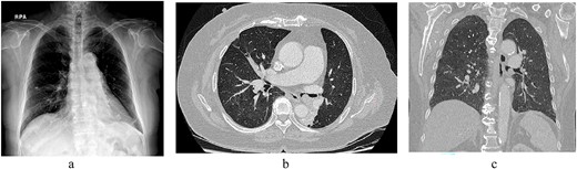 (a) Chest radiogram shows a possible tumor in the left main bronchus and atelectasis of the left lower lobe. (b) A chest computed tomography scan confirmed an endobronchial tumor obstructing the left lower lobe bronchus that was growing toward and nearly completely blocked the main bronchus. (c) Coronal view.