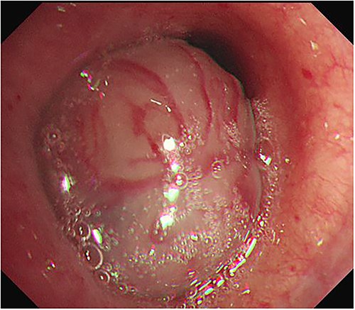 Bronchoscopy was performed and revealed an endobronchial tumor with a smooth surface that was obstructing most of the left main bronchus.