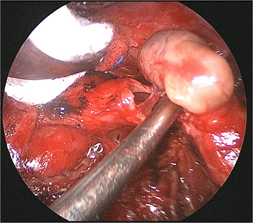 Operative findings. The tumor, which measured 1.8 × 0.8 cm, had a thin stalk attached to the left lower lobe bronchus. No invasion of the tumor into the surrounding tissue was observed.