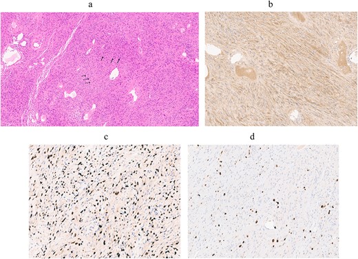 Pathological images. (a) On higher power (×20, objective), the tumor was composed of spindle cells with areas of hypercellular Antoni A (arrows) and hypocellular Antoni B (dotted line arrows). The tumor also had occasional cystic changes, hemosiderin pigments, and diffuse lymphocytic infiltration, all characteristics of an ancient schwannoma. (b, c) Immunohistochemical staining results showed uniform intensity for S-100 protein and SOX10. (d) The Ki67 LI staining was positive in <5% of cells.