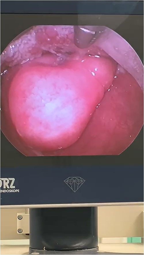 Strobolaryngoscopy image shows the mass above the left vocal cord.