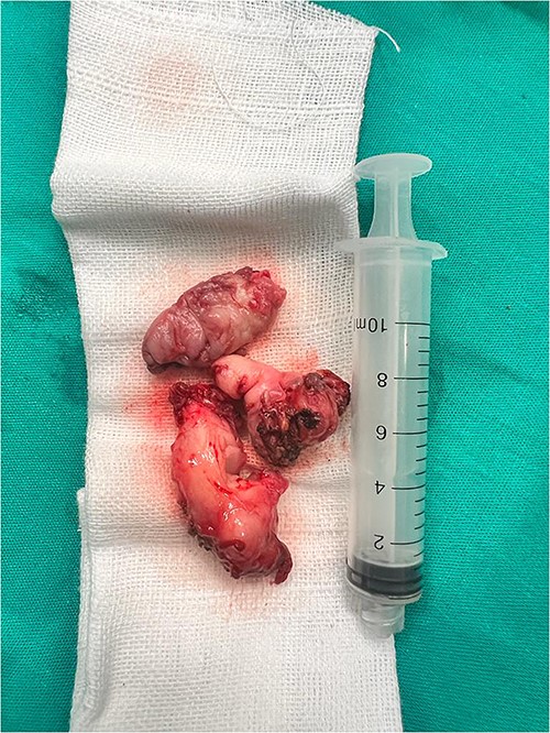The gross image of the mass shows multiple fragments, all measuring 7 cm.