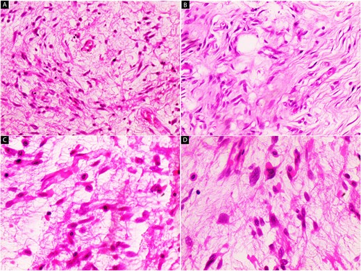 Hematoxylin and eosin stain (A–D); microscopic images of mass; (A) the low-power magnification shows diffuse and nodular proliferation of bland fusiform or stellate neoplastic cells in a myxoid stroma (40×); (B) the fibrotic areas are more cellular but the cells themselves appear similar to those in the myxoid areas (100×); (C and D) Bland fusiform or stellate neoplastic cells have small hyperchromatic nuclei (200× and 400×).