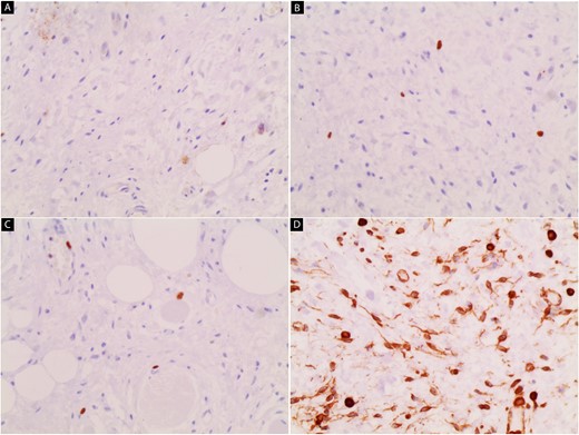 Immunohistochemical stain image; (A) cytokeratin is negative; (B and C) the ki67 rate is very low; (D) tumor cells show positivity to vimentin.