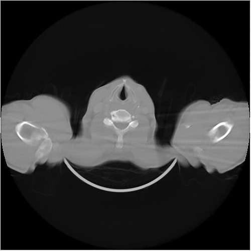 CT scan of the neck and throat image shows no signs of tumor recurrence or metastases.