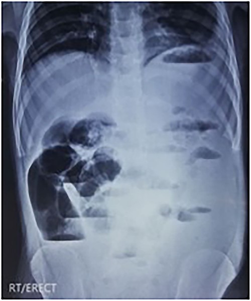 X-ray of abdomen erect view showing multiple air-fluid levels.