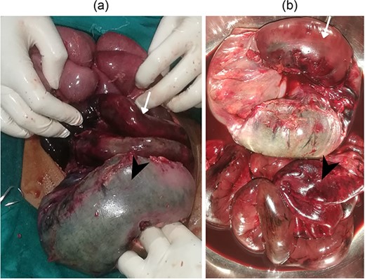 (a) Gangrenous ileum (arrow) and sigmoid (arrow head) (b) resected gangrenous ileum (arrow head) and sigmoid (arrow).