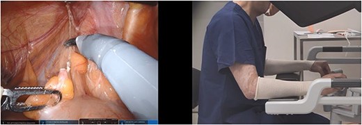 Ergonomic VPM; the instrument tip positions are misaligned in up–down position and the surgeon hands are aligned at the robotic console (scissors in right hand and bipolar forceps in left hand).