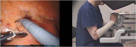 Nonergonomic and no VPM; the instrument tip positions are misaligned in up–down position and the surgeon hands match this misalignment at the robotic console (scissors in right hand and bipolar forceps in left hand).