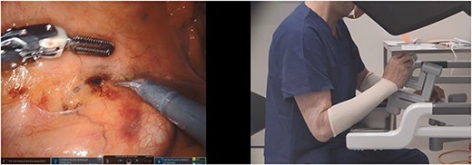 True VPM; the instrument tip positions are misaligned in up–down position and the surgeon hands are misaligned in the opposite direction at the robotic console (scissors in right hand and bipolar forceps in left hand).
