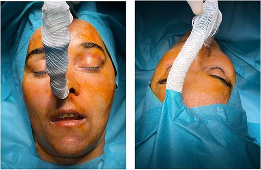 Front and basal views of cheeks projection.