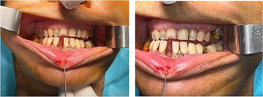 Patient’s occlusion (front and lateral view).