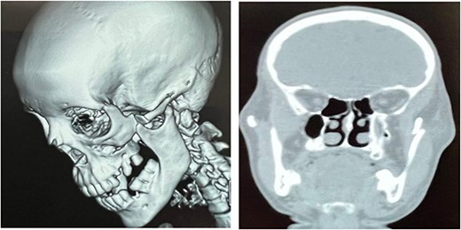 CT scan showing dislocation of the coronoid process above the ZMC fracture.