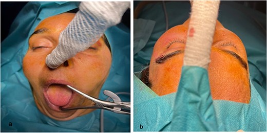 (a) Mouth opening; (b) reestablishment of the cheek’s projection.