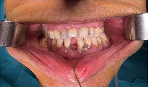 Post-op occlusion.