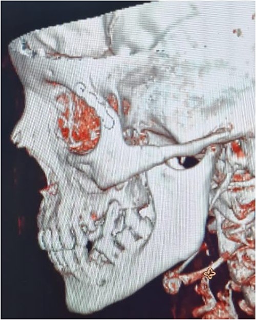 Postop CT scan.