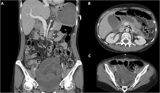 Pre-operative CT-abdomen pelvis of a closed loop bowel obstruction. (A) Coronal cross section. (B) Sagittal cross section of the abdomen. (C) Sagittal cross section of the pelvis.