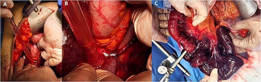 Intraoperative ischaemic bowel. (A) Identification of the transition point for the ischaemic bowel and suture in the left iliac fossa. (B) The suture placed during previous robotic surgery transecting the bowel and resulting in a volvulus. (C) 1.2 metres of ischaemic terminal ileum.