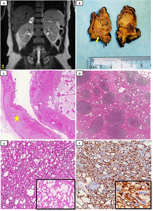 (A) MRI with pre- and postcontrast administration showed stable right multilocular cystic adrenal lesion with high signal intensity in T2-weighted images; (B) gross examination after serial sections reveals a well-demarcated nodule measuring 3.6 × 3 × 2.5 cm, composed of a multi-cystic lesion; a rim of normal adrenal gland is noted to be remaining (yellow arrow); (C): histopathology examination by hematoxylin and eosin stain (H&E) reveals a demarcated lesion composed of micro and macrocytic spaces, with adjacent normal adrenal gland tissue observed (yellow star) (H&E; 4×); (D) lymphoid aggregates are commonly encountered in these tumors as seen here (H&E; 10×); (E) tumor cells composed mostly of microcysts arrangement (H&E; 40×), with the inset showing tumor forming channels giving an alveolar appearance (H&E; 40×); (F) tumor cells show diffuse strong Calretinin positivity (20×), with high power magnification (40×) (inset).