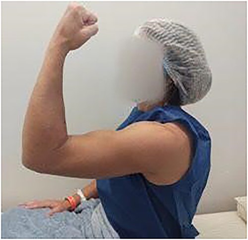 Inverted Popeye sign.