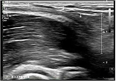 Ultrasound image showing discontinuity of the DBT.