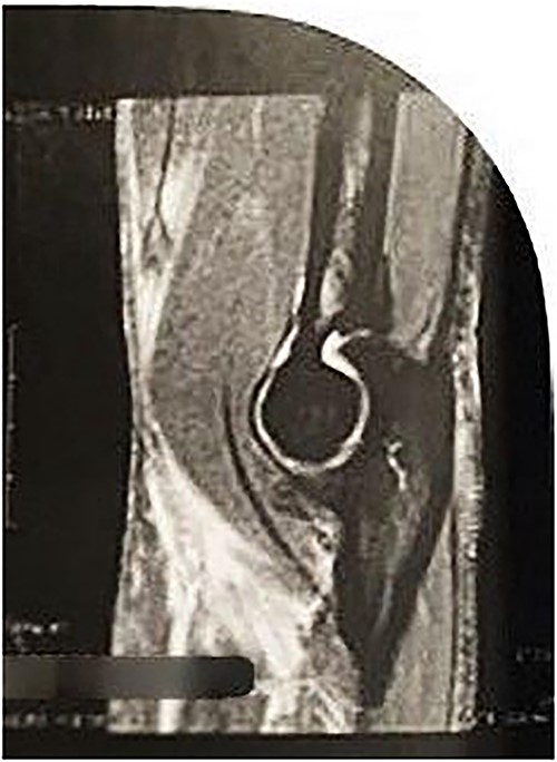 Sagittal MRI Image revealing discontinuity of the DBT and edema in the insertion region.