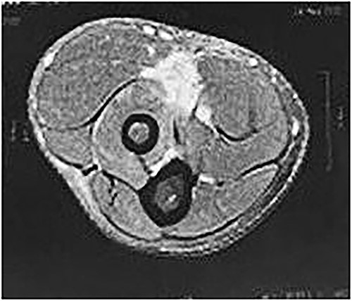 Axial MRI image showing absence of the biceps tendon in the region of the radial tuberosity and edema in the area.