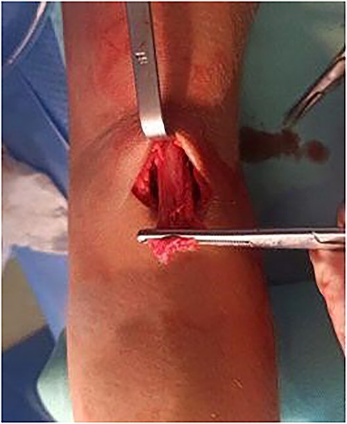 Intraoperative clinical image of complete DBT rupture.