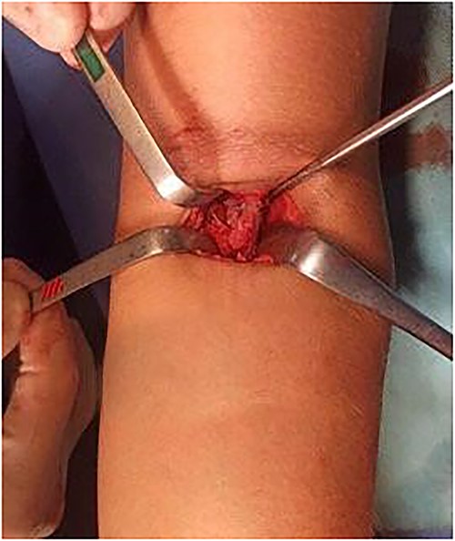 Clinical image of DBT reinserted into the radial tuberosity.