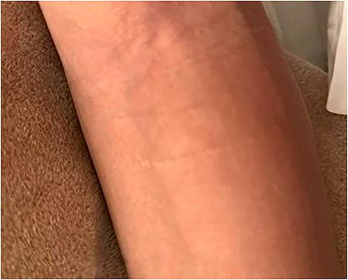 Clinical image of scar appearance 2 years after surgical procedure.