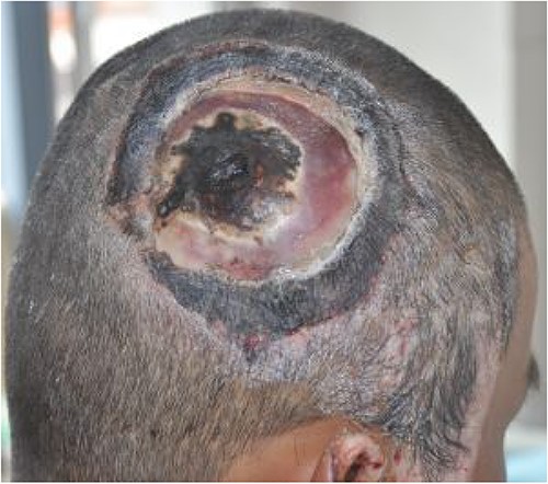 Skull exposure of ~8 cm × 9 cm, the bone being dark, and a cortex skull defect of ~3 cm × 3 cm.