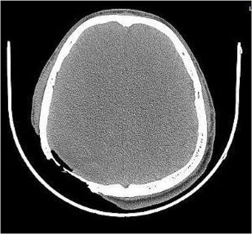 CT shows the presence of gas inside the skull.