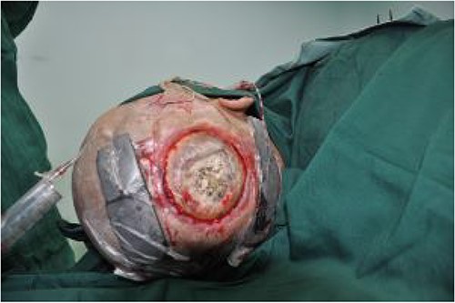 Defect of the inner plate of the skull of ~1 cm × 1 cm, with exposure of the dura mater.