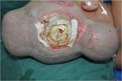 Regular injection of two dilators for dilation.